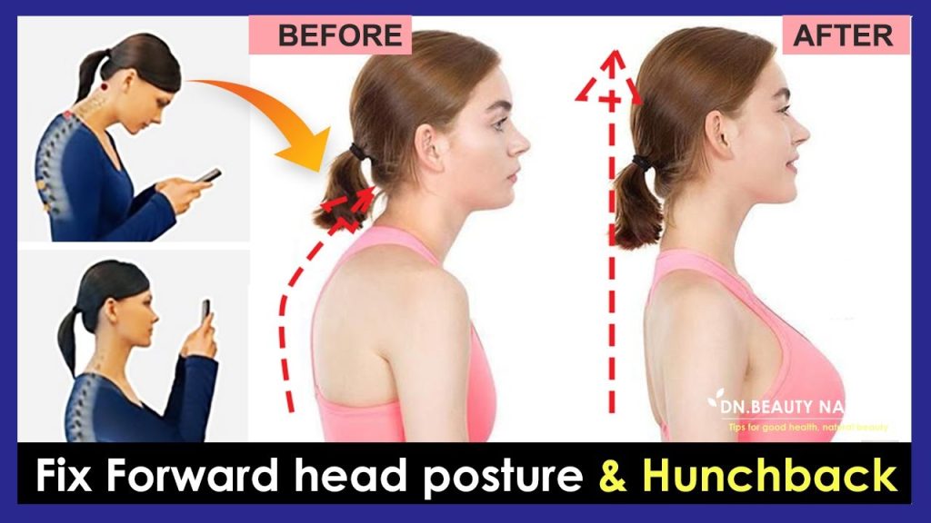 Can Forward Head Posture Be Corrected? A Complete Guide