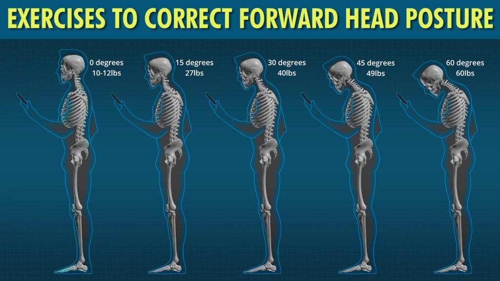 Effective Solutions to Fix Forward Head Posture