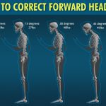 Effective Solutions to Fix Forward Head Posture